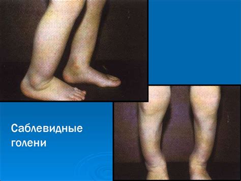 Врожденный сифилис - презентация онлайн