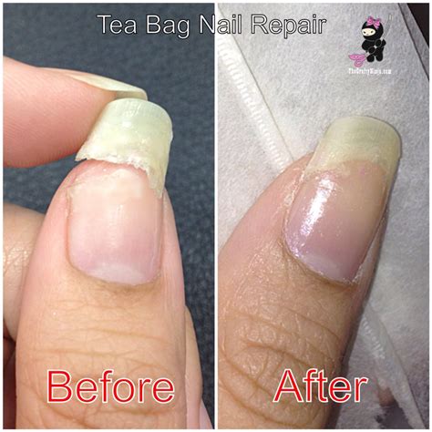 How To Repair A Torn Nail Bed at Alex Ann blog