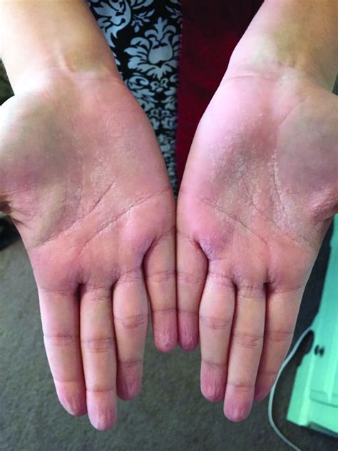 Atopic Dermatitis Palms