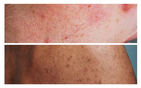 Post inflammatory hyperpigmentation Vs Post inflammatory erythema ...