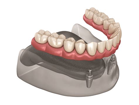 Snap On Dentures | Clip On Dentures Near Me