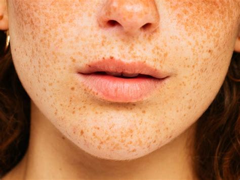 brown spots  lips reddit lipstutorialorg