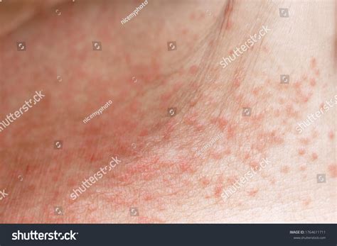 skin disease prickly heat rash miliaria foto stok  shutterstock