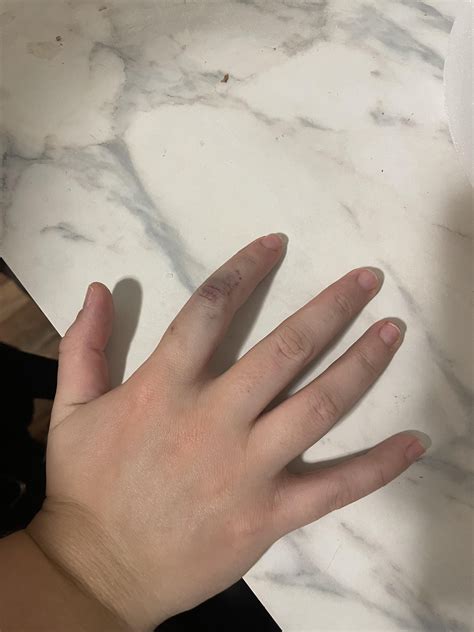 My gf has had this bruise for a few years and it flares up sometimes