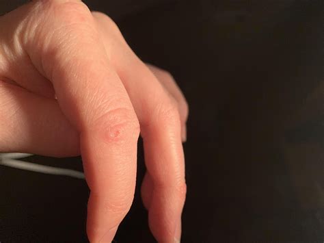 Before and after another round of Scholl’s wart and verruca pen - it