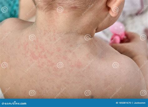 Roseola Rash a Viral Rash on the Skin of a Child Stock Photo - Image of ...