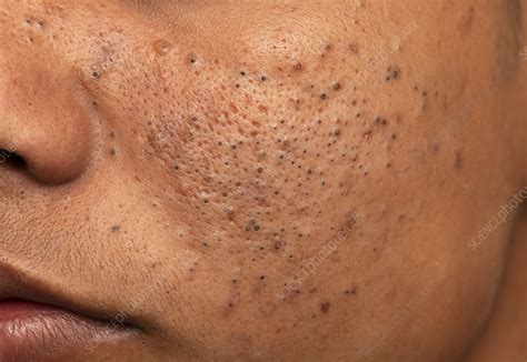 Acne vulgaris - Stock Image - C052/5436 - Science Photo Library