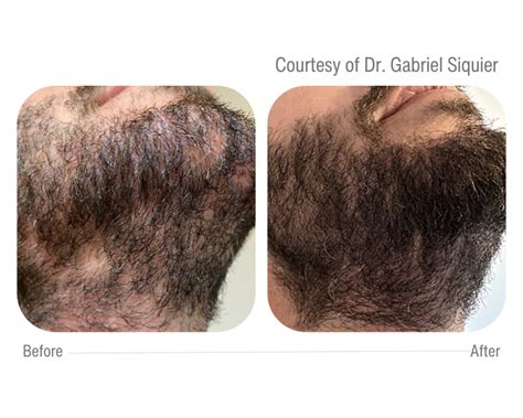 Meso-Hair - Final Shape