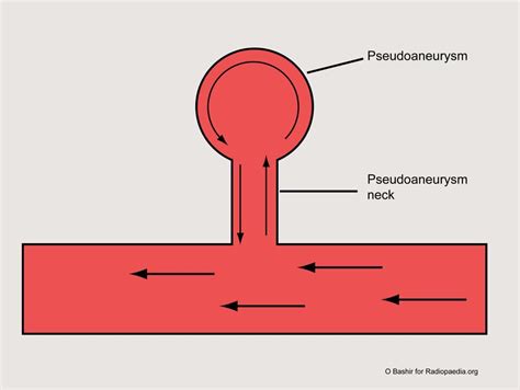 Pseudoaneurysm | Radiology Case | Radiopaedia.org | Diagnostic medical ...