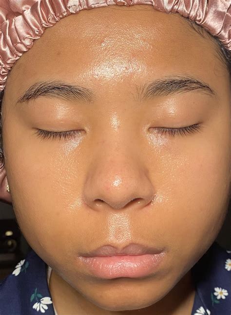 Fungal Acne Vanished: How I did It/ Previous Reddit Reccs that did NOT