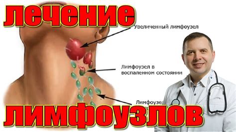 Лечение лимфоузлов на шее Oтзыв врача - YouTube