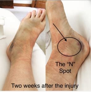 Navicular Stress Fracture Top Of Foot
