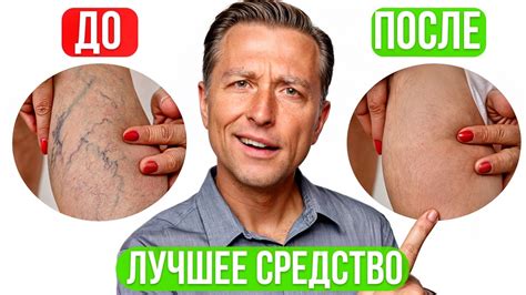 Варикоз — симптомы и лечение