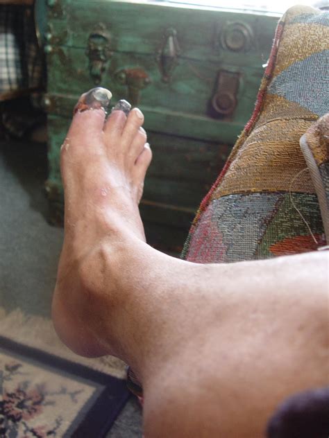 Gangrene