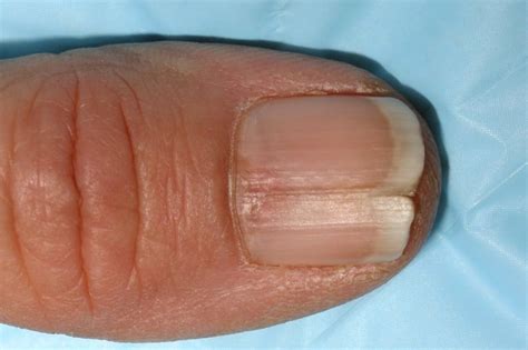 What Are The Triggers Of Vertical Split Nails? 15 Common Causes ...