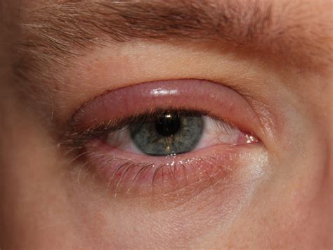 swollen eyelid  blepharitis allergies
