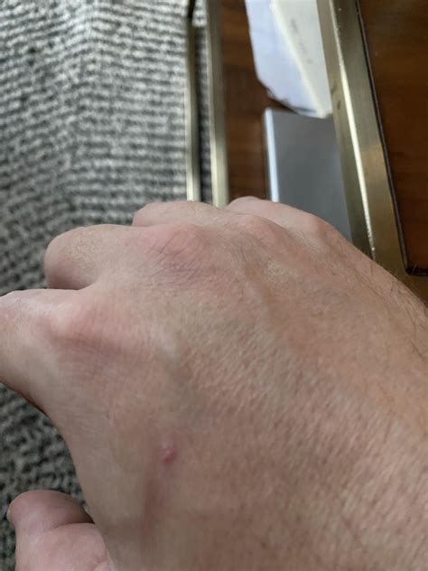 Is this a wart? Small lump on my hand with tiny white dots inside