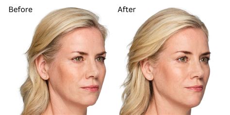volux xc dr chernoff plastic surgery