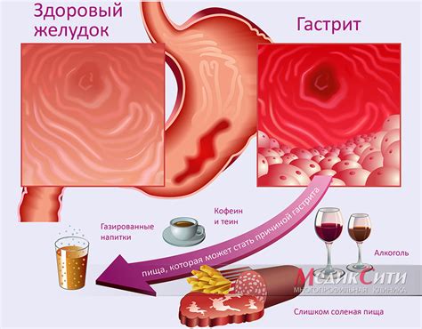 Что такое гастрит по старому