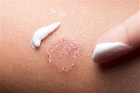 Thuốc Kedermfa Cream: Tác dụng, liều dùng và chống chỉ định