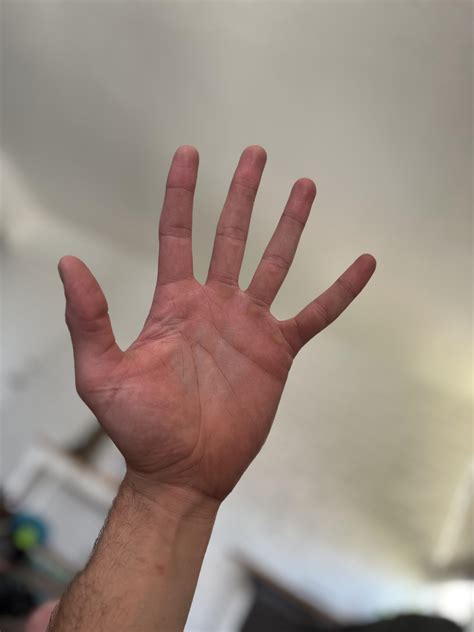 Please ignore my gross calluses, but does anyone have any idea why my