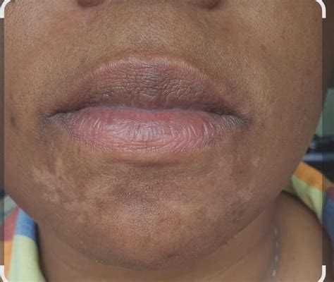 skin rash  face rdermatologyquestions