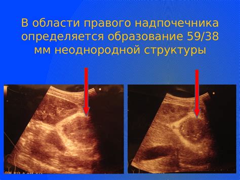 Опухоли надпочечника фото