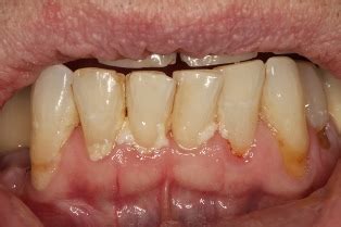 bacterial plaque      tartar  dental plaque