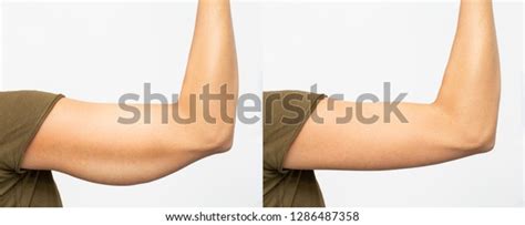 Before After Excess Skin Removal Under Stock Photo (Edit Now) 1286487358