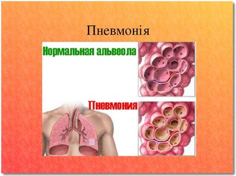Пневмонія - презентація з медицини