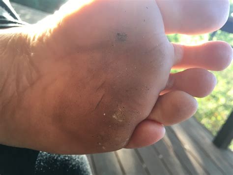 Warts after about 1 month of liquid nitrogen treatment : r/Warts