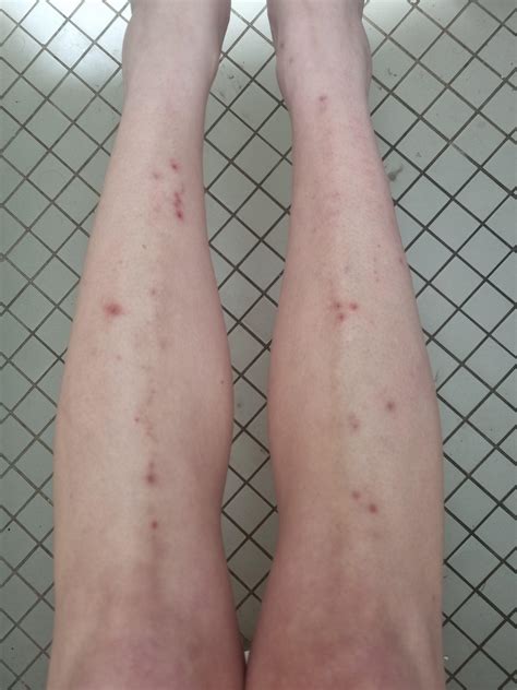 Dermatitis Herpetiformis help? Question in comments : r/Celiac