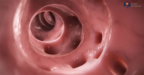 Diverticulose Cólica Tem Cura - Diverticulose De Colon Esquerdo - NAZAEDU