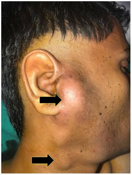 tmj  parotid gland swelling