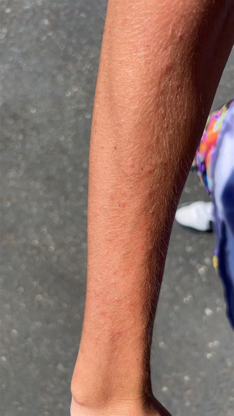 how to know if you have sun poisoning 8