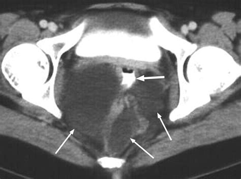 Retroperitoneal Cystic Masses: CT, Clinical, and Pathologic Findings ...