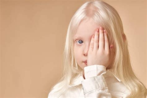 Albinism and Albinism Treatment: What You Need To Know