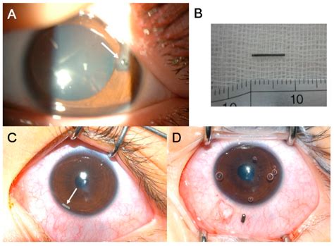 Intraocular Foreign Body: Diagnostic Protocols and Treatment Strategies