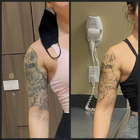 Tattoo Removal restored my confidence! : r/TattooRemoval