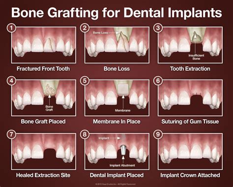 bone grafting  dental implants sherway gardens dental centre