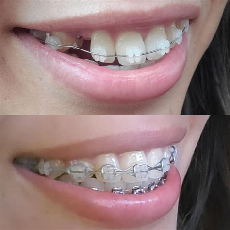 “Do braces change your facial or jaw structure?” : r/braces