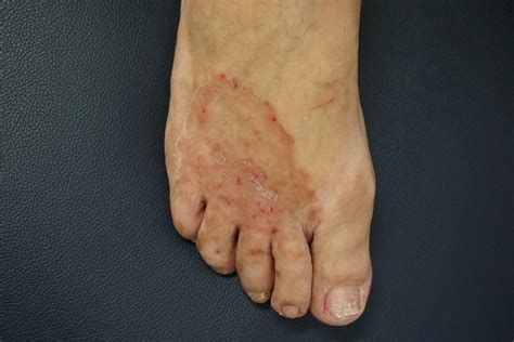 Plantar and cutaneous warts: A guide to diagnosis, treatment, and