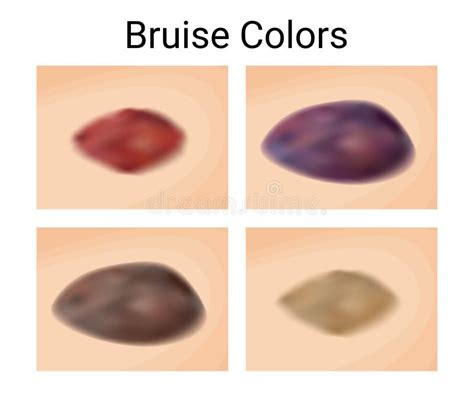 Healing Stages of Bruises and Hematomas Stock Vector - Illustration of ...
