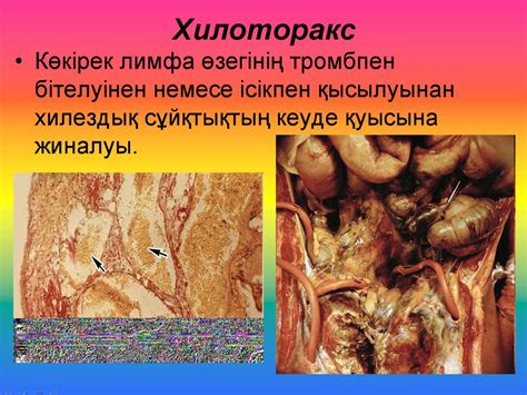 Лимфа айналымының бұзылуы: лимфа түзілуінің бұзылуы. Лимфедема ...