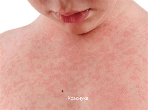 Список наиболее распространенных инфекционных заболеваний, которые ...