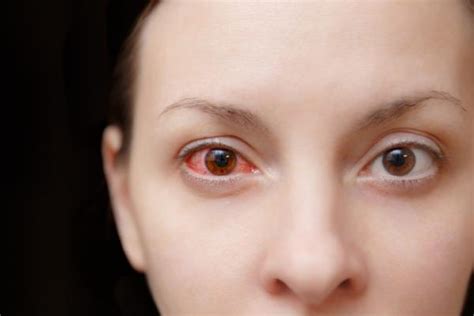 Derrame en el ojo por estrés: causas y tratamiento