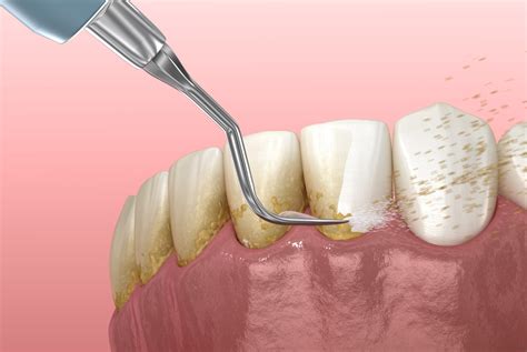 dental scaling  kinds  methods serenity clinic dubai