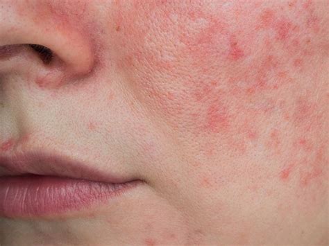 Lupus Rash vs. Rosacea: What’s Causing My Butterfly Rash?