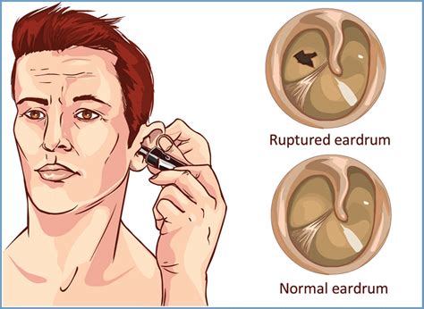 tympanoplasty ear drum repair yellowstone surgery center