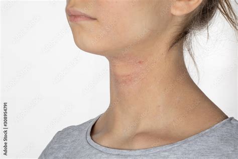 Allergic itchy skin on girl neck. Teen with rash dry skin on neck ...